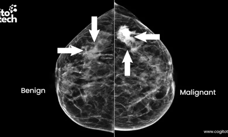 Mammogram Data Annotation for AI-Driven Breast Cancer Detection